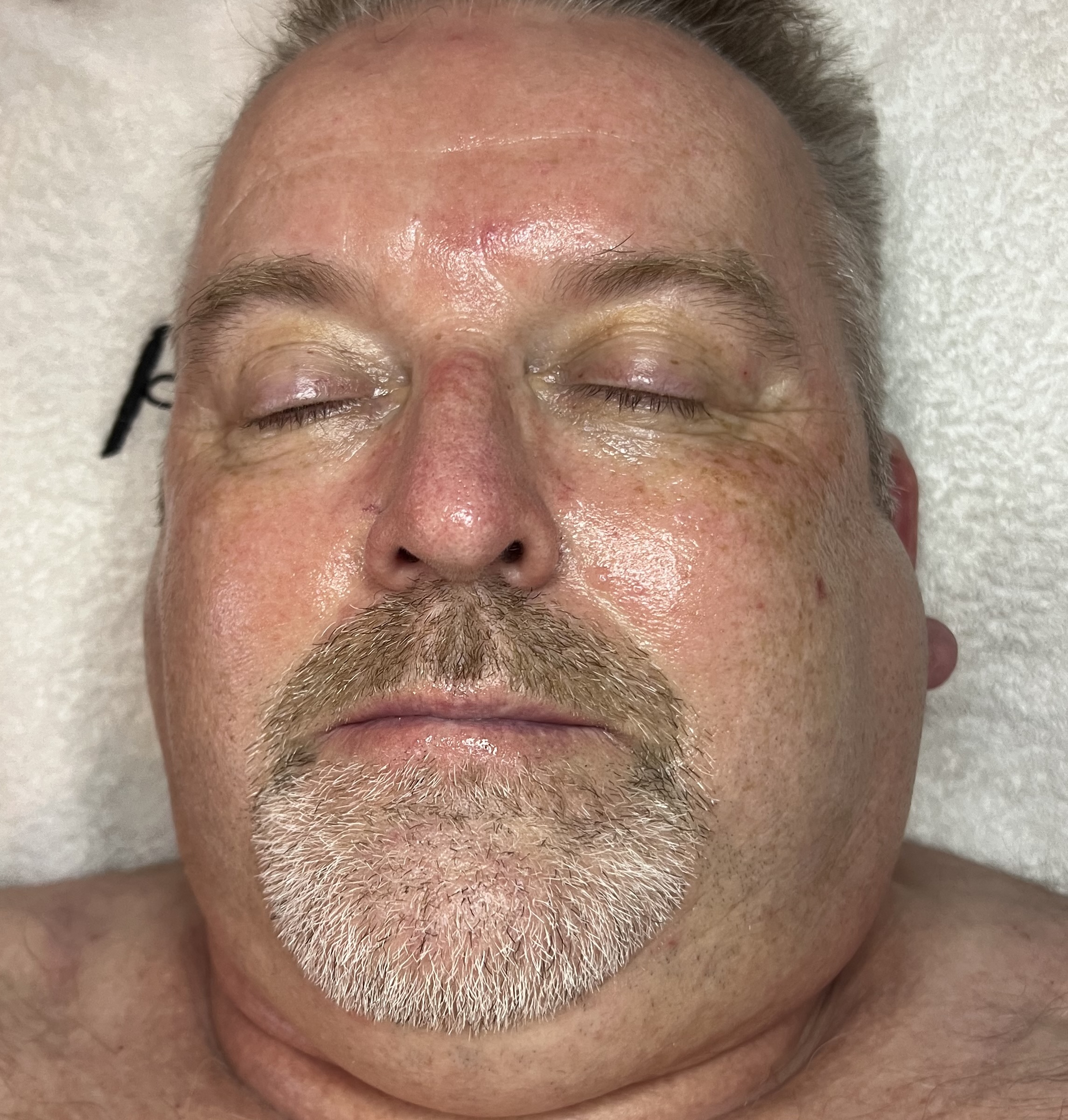 Efter ansigtsbehandling for mænd