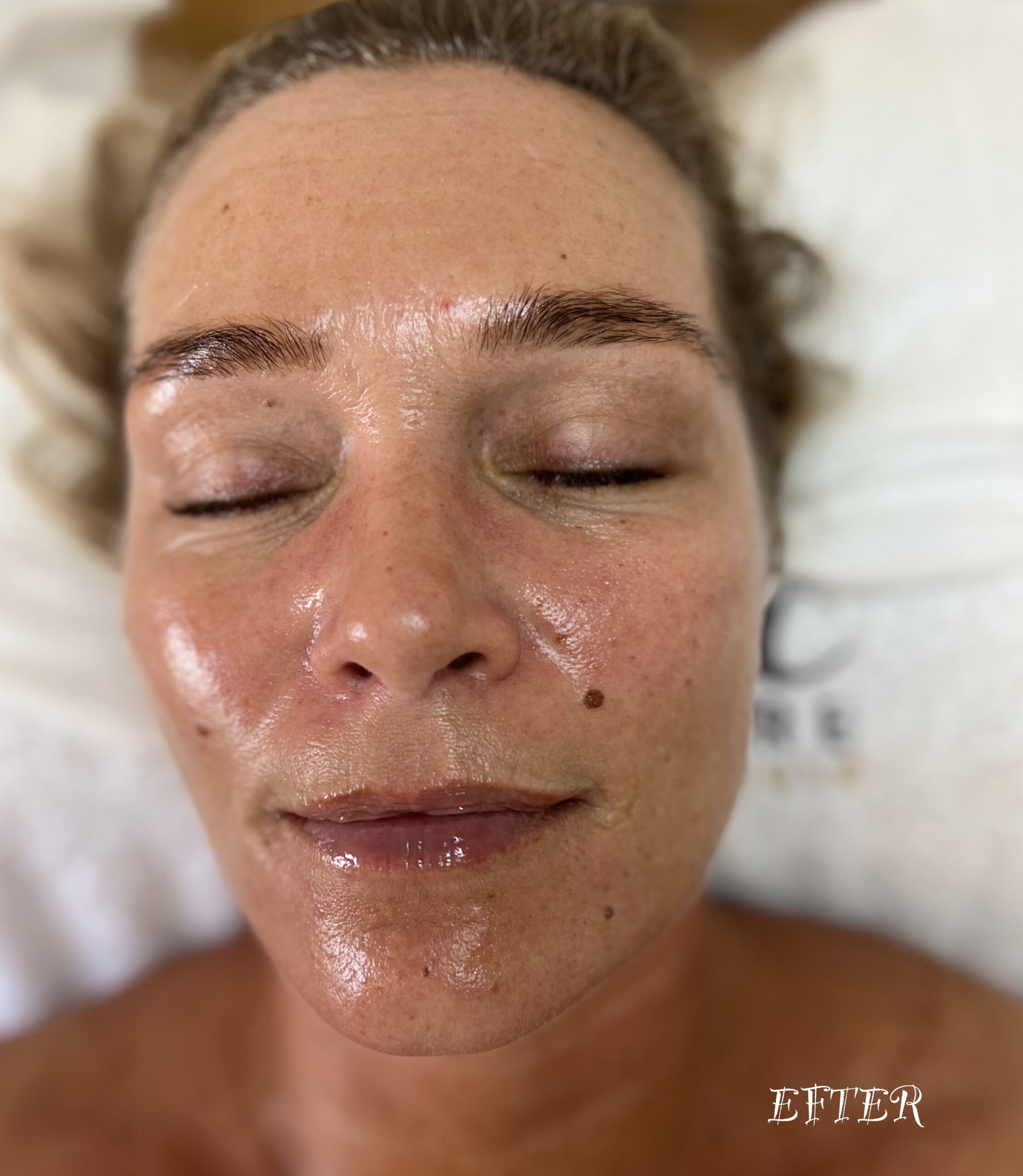 Efter oxygen ansigtsbehandling
