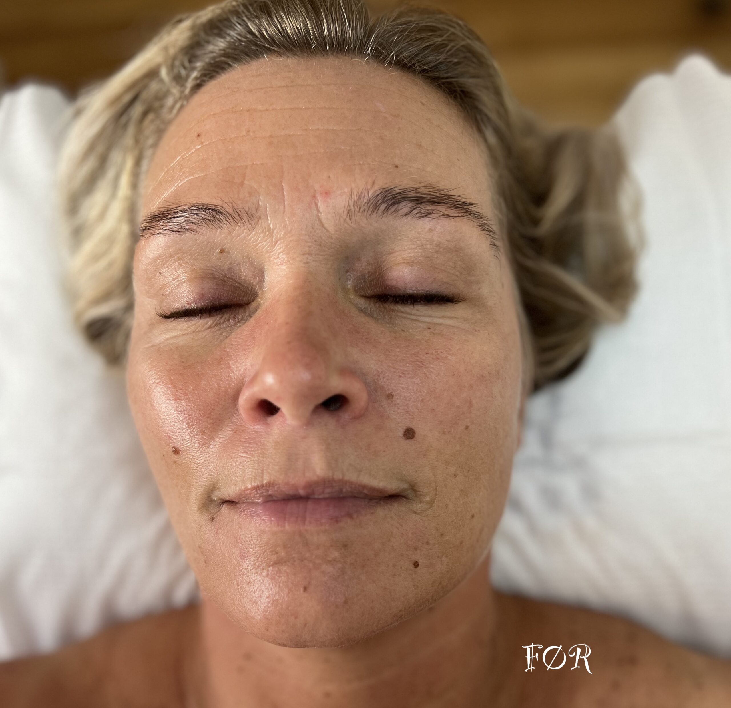 Før oxygen ansigtsbehandling
