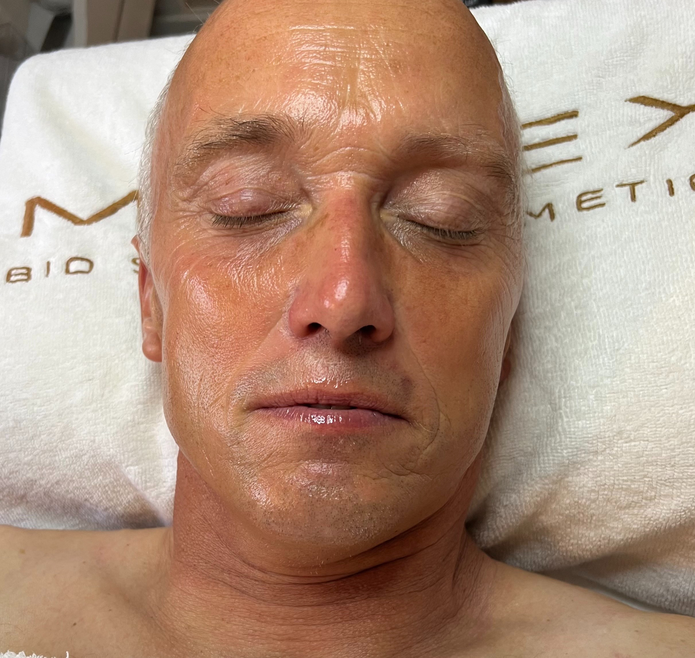 Efter MEDEX ansigtsbehandling